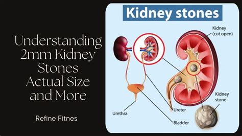 How Big is a 2mm Kidney Stone: A Grain of Sand or a Mountain of Pain?