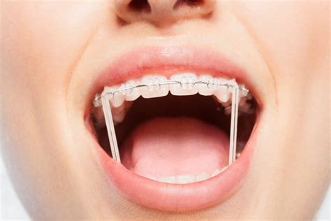 How Do Rubber Bands Work on Braces: The Elastic Mechanics of Orthodontic Alignment